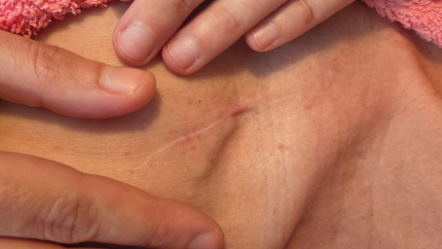 scar
